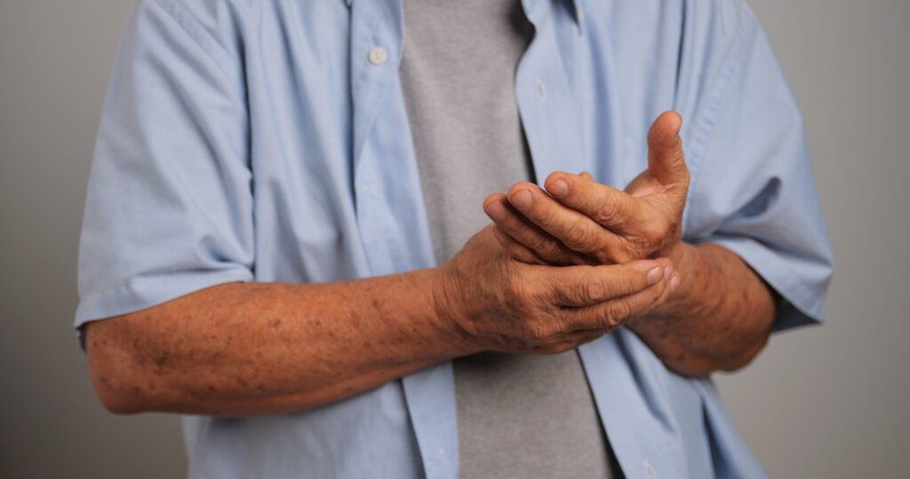 An Asian man has tingling and numbness in his hand which causes beriberi.